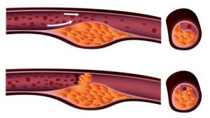 Efecto del colesterol sobre las arterias- Fotolia