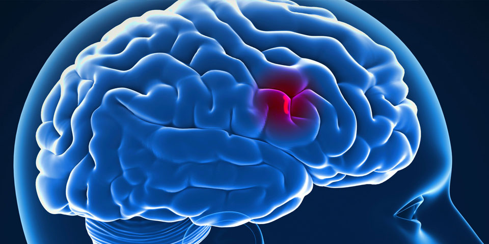 Conocer los síntomas de ataque cerebral puede salvar vidas
